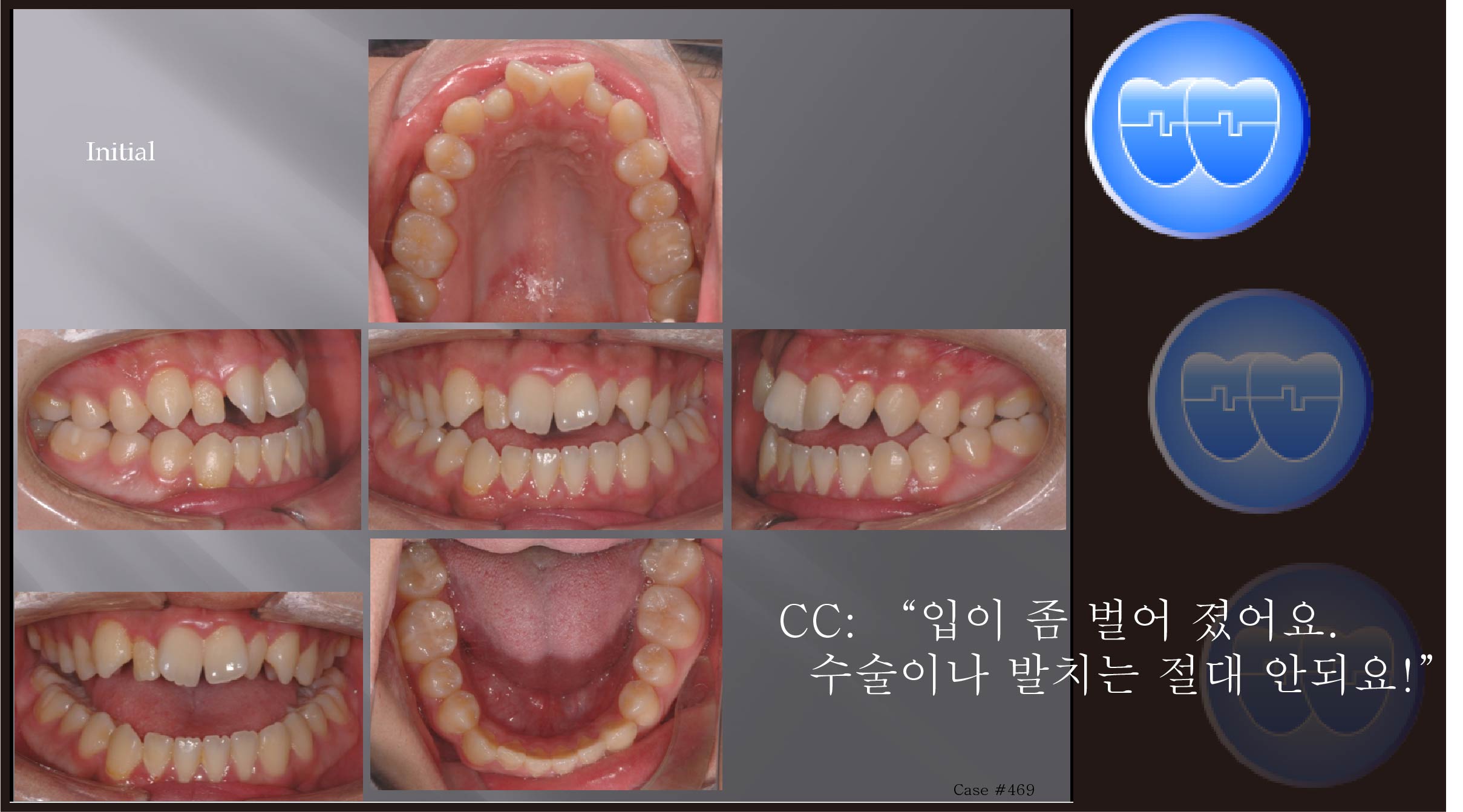 교정 Case 469.  비발치, Class III, Dental Openbite, Functional Shift, Molar Intrusion, Sem #7