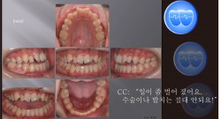 교정 Case 469.  비발치, Class III, Dental Openbite, Functional Shift, Molar Intrusion, Sem #7