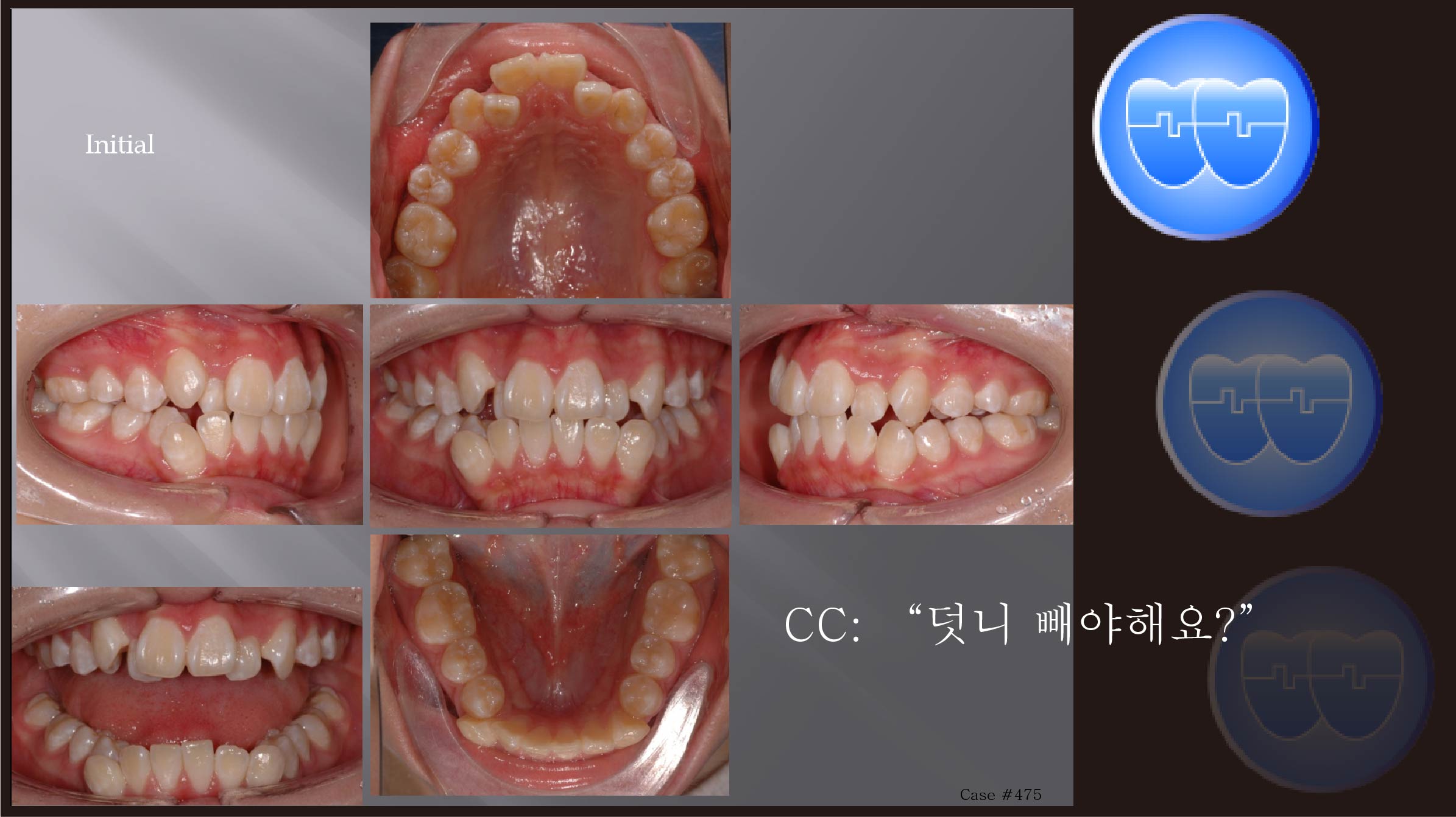 교정 Case 475.  U5L4 발치, Upper NiTi 끊어짐, Sem #12.3