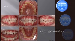 교정 Case 475.  U5L4 발치, Upper NiTi 끊어짐, Sem #12.3