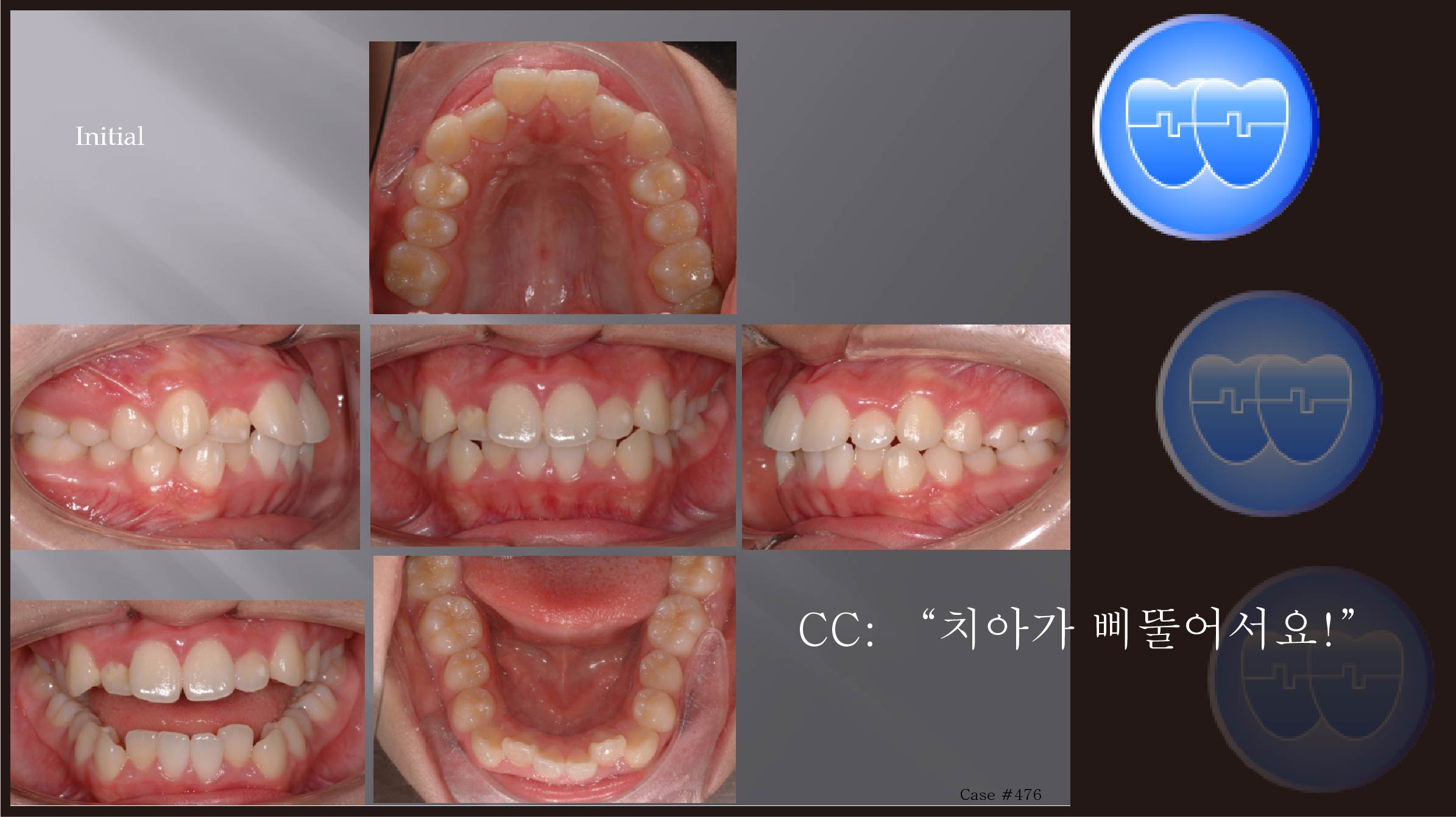 교정 Case 476.  U5L4 발치, Skeletal Class II, Gummy Smile, Relapse, #23 신경죽음, Sem #7.5