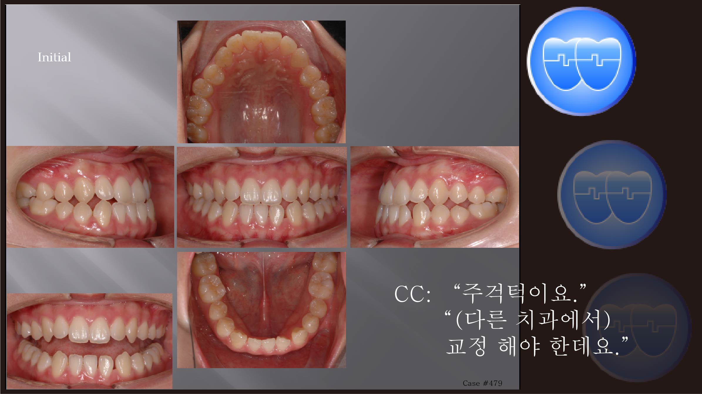 교정 Case 479.  비발치,Class III, Space, Three Lower Incisors, Sem #7