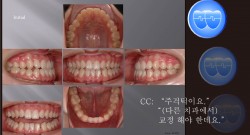 교정 Case 479.  비발치,Class III, Space, Three Lower Incisors, Sem #7