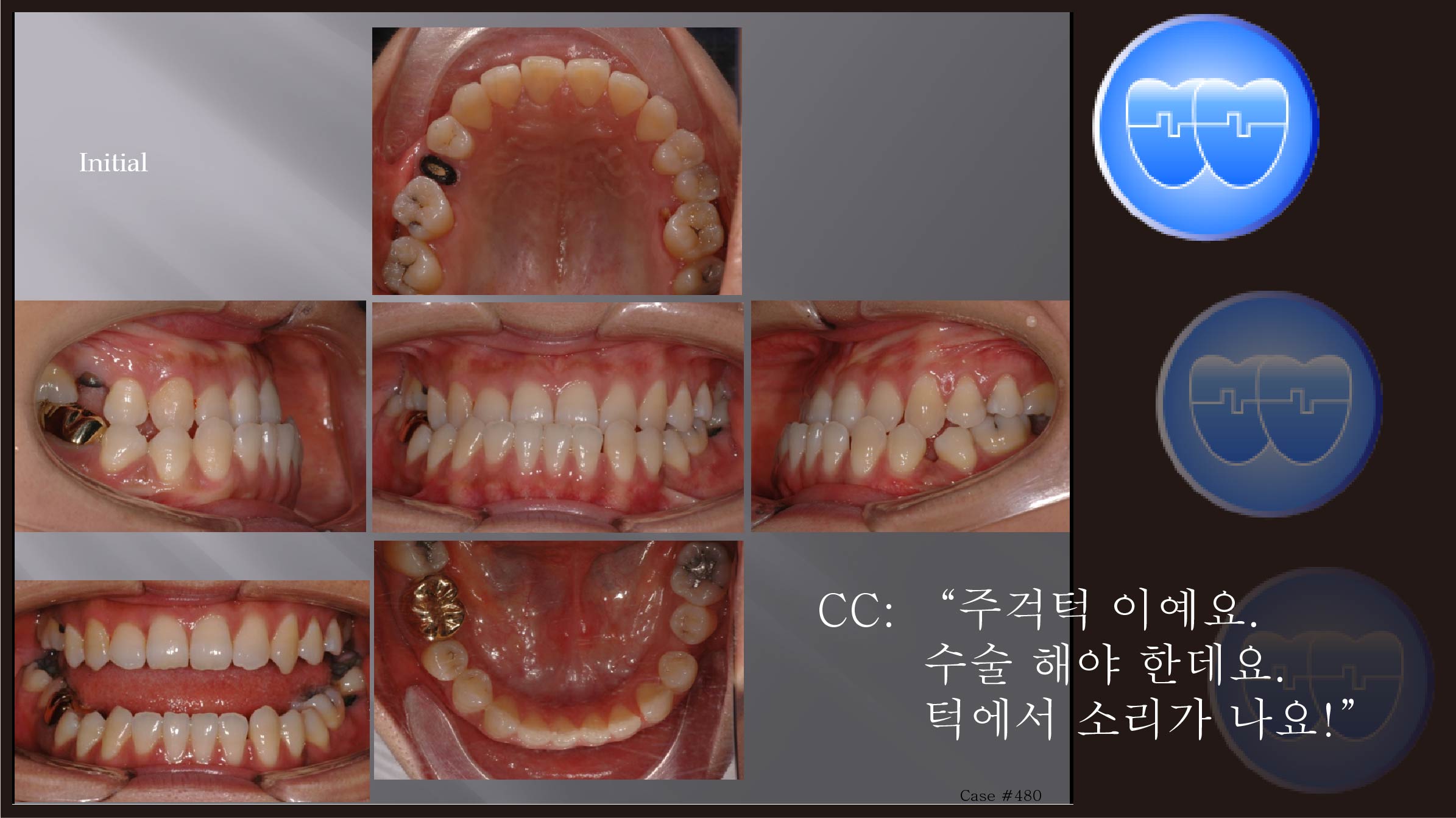 교정 Case 480.  비대칭 발치, Class III, 심각한 주걱턱, Lower Lingual Corticotomy, Popping Sound, TMJ, Sem 13.2