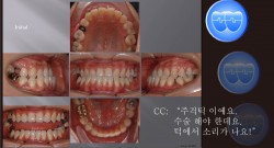 교정 Case 480.  비대칭 발치, Class III, 심각한 주걱턱, Lower Lingual Corticotomy, Popping Sound, TMJ, Sem 13.2