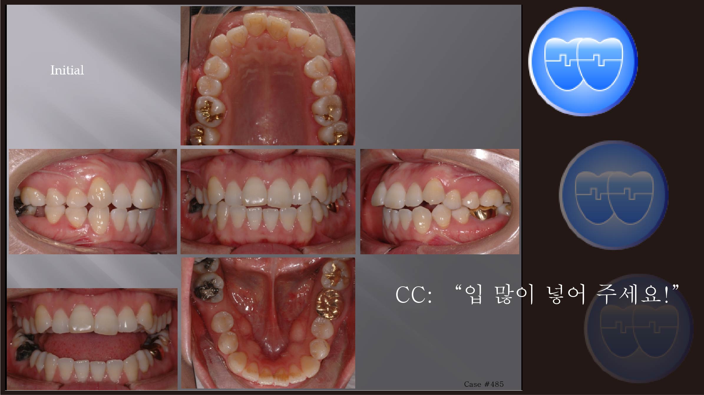 교정 Case 485.  Molar Substitution for Lower, Root Resorption, Sem#13.2