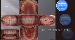 교정 Case 485.  Molar Substitution for Lower, Root Resorption, Sem#13.2