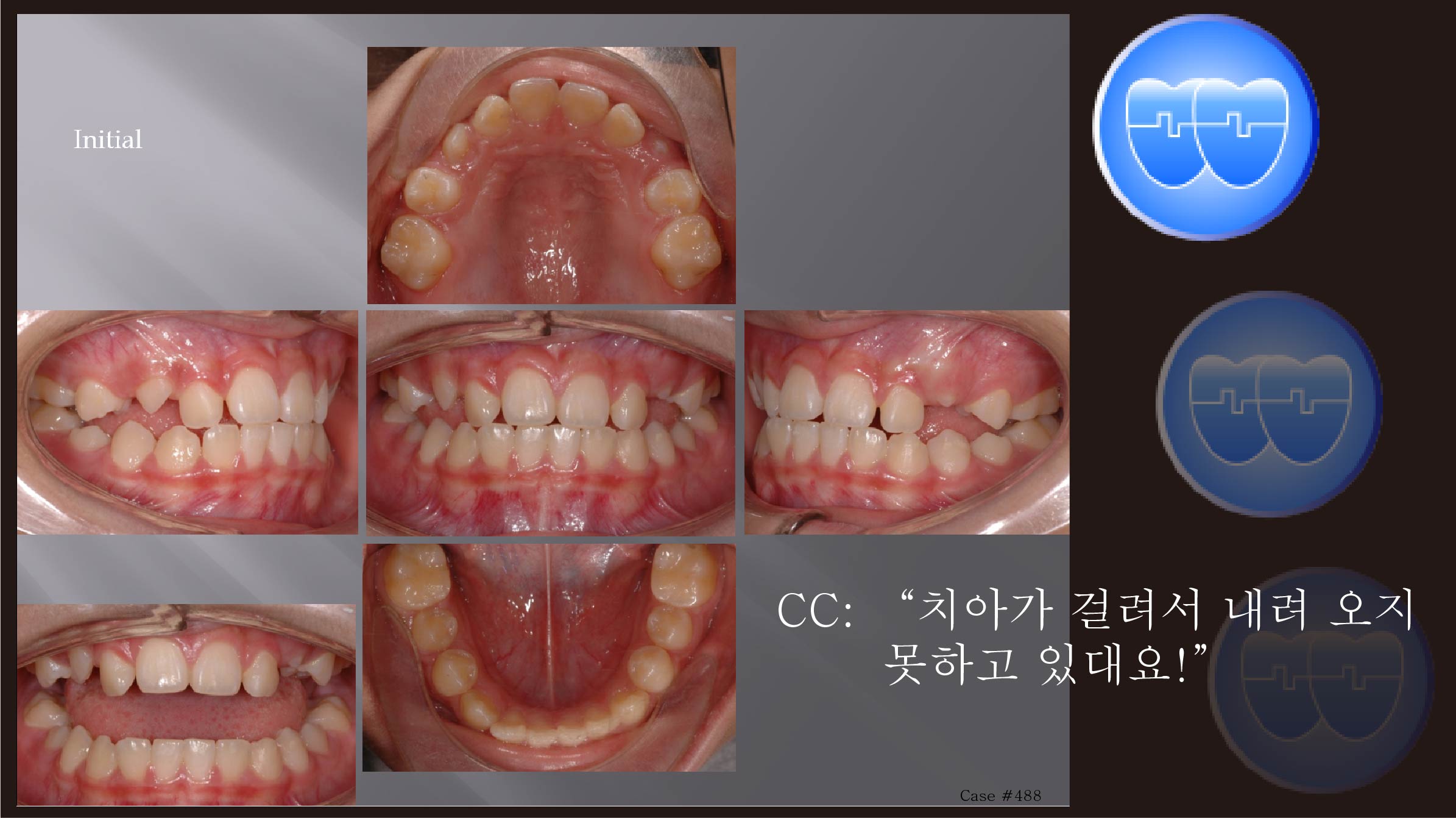 교정 Case 488.  비발치, #15, #25 Blockout (Impaction), Sem #14