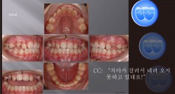 교정 Case 488.  비발치, #15, #25 Blockout (Impaction), Sem #14