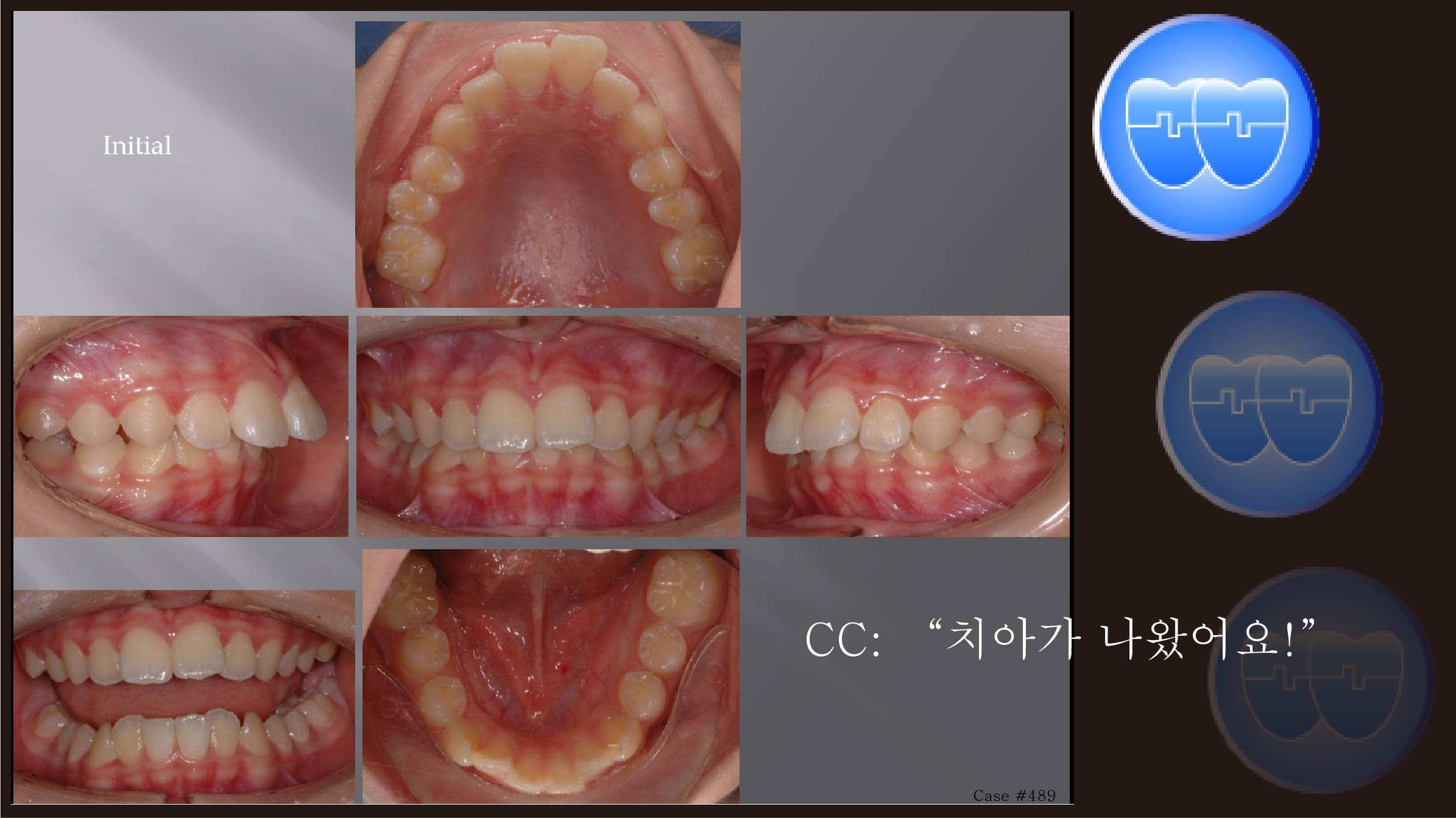 교정 Case 489.  U4 발치, Severe Class II, Early DBS & Root Formation, Sem #12.5