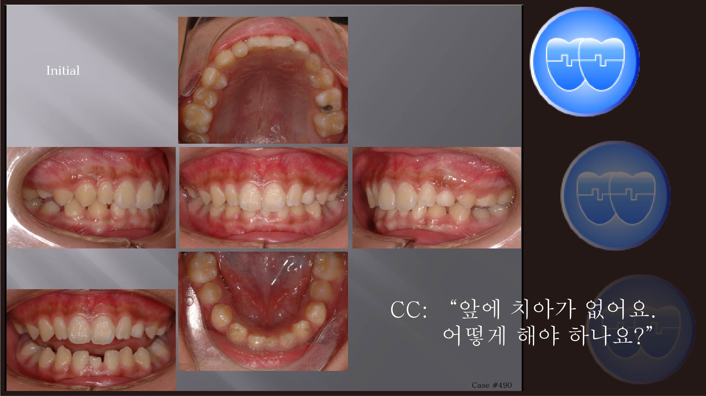 교정 Case 490.  Congenital Missing of Two Lower Incisors, Sem #13