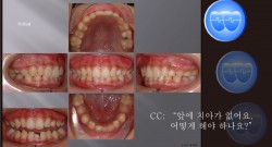 교정 Case 490.  Congenital Missing of Two Lower Incisors, Sem #13