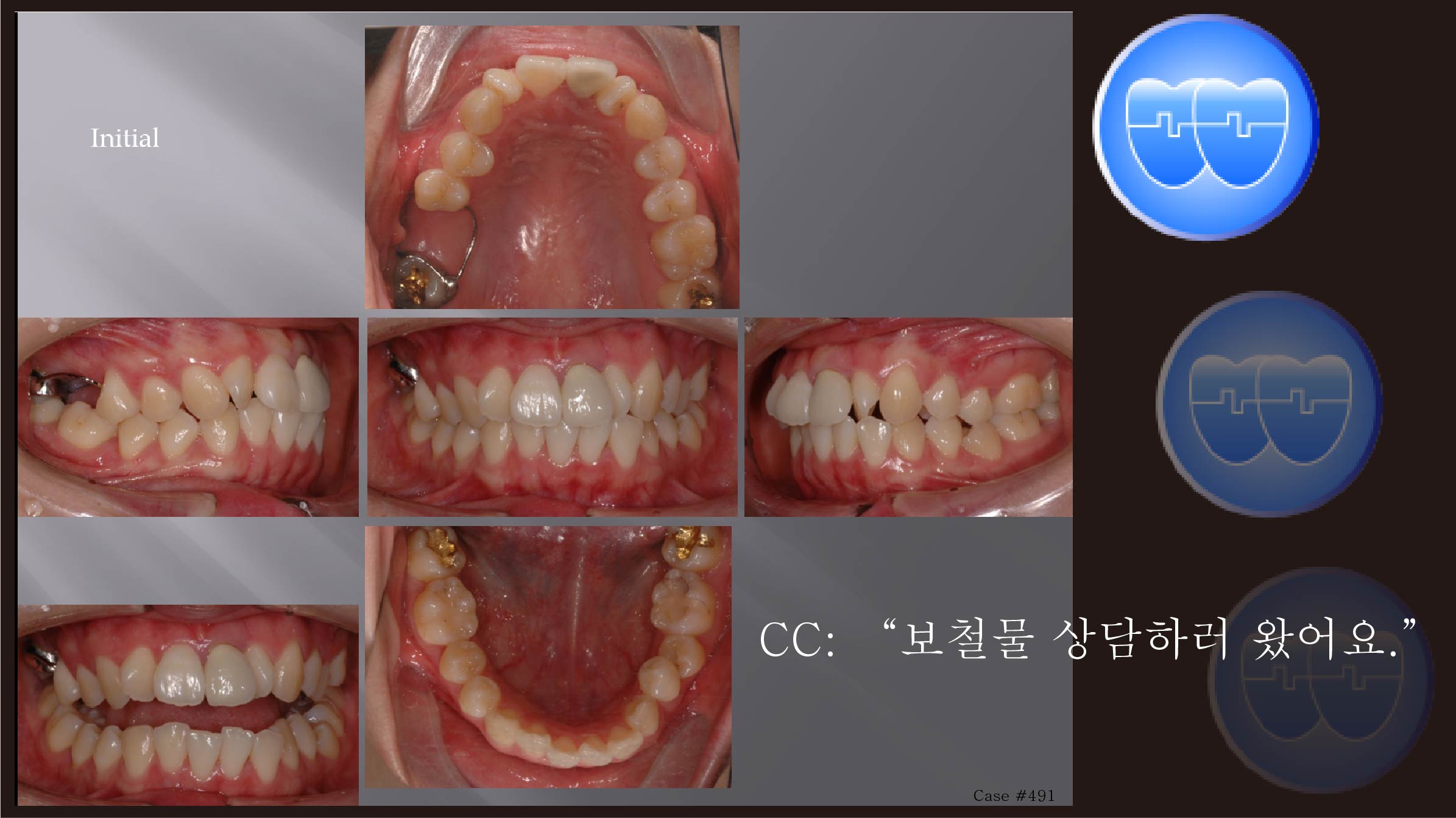 교정 Case 491.  비대칭 발치, Upper Molar Extraction, Low Sinus, Sem #13.2