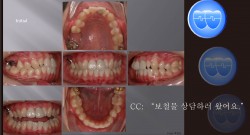 교정 Case 491.  비대칭 발치, Upper Molar Extraction, Low Sinus, Sem #13.2