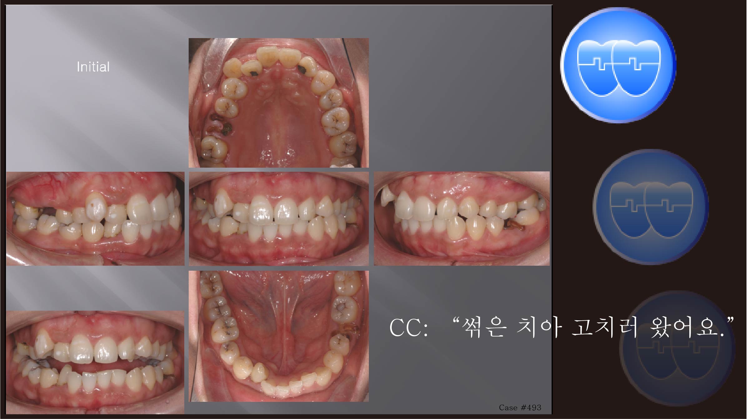 교정 Case 493.  비대칭 발치, Impacted Canine, Molar Substitution, Sem #13.2