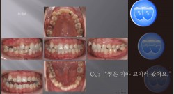 교정 Case 493.  비대칭 발치, Impacted Canine, Molar Substitution, Sem #13.2