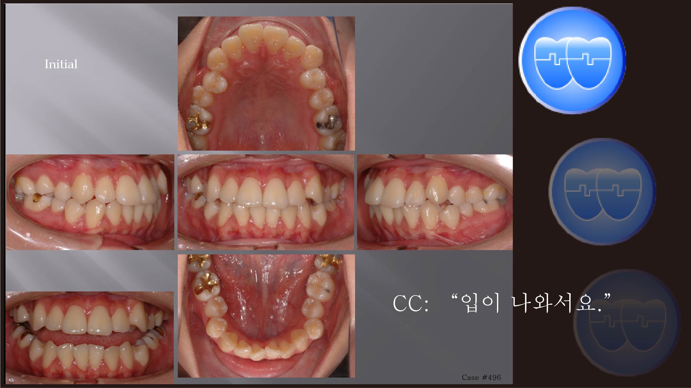 교정 Case 496.  U5L4 발치, Skeletal Class III, Proclined Upper Incisors, Sem #12.3