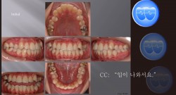 교정 Case 496.  U5L4 발치, Skeletal Class III, Proclined Upper Incisors, Sem #12.3