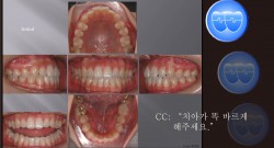 교정 Case 499.  비발치, Expansion과 Stripping으로만 Retraction, Sem #5