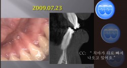 교정 Case 502.  U4L4 발치으로 교정 생긴 문제, Thin Symphysis의 위험성, Sem #7