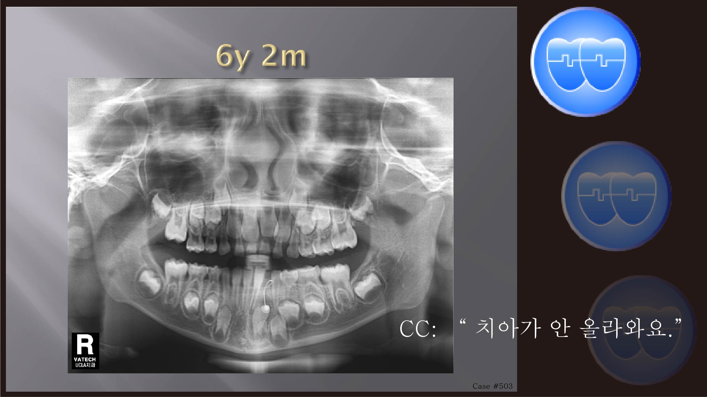 교정 Case 503.  1차 교정, Odontoma, Impaction of #32, Sem #9