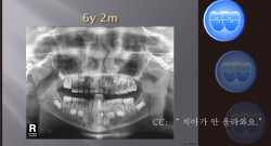 교정 Case 503.  1차 교정, Odontoma, Impaction of #32, Sem #9