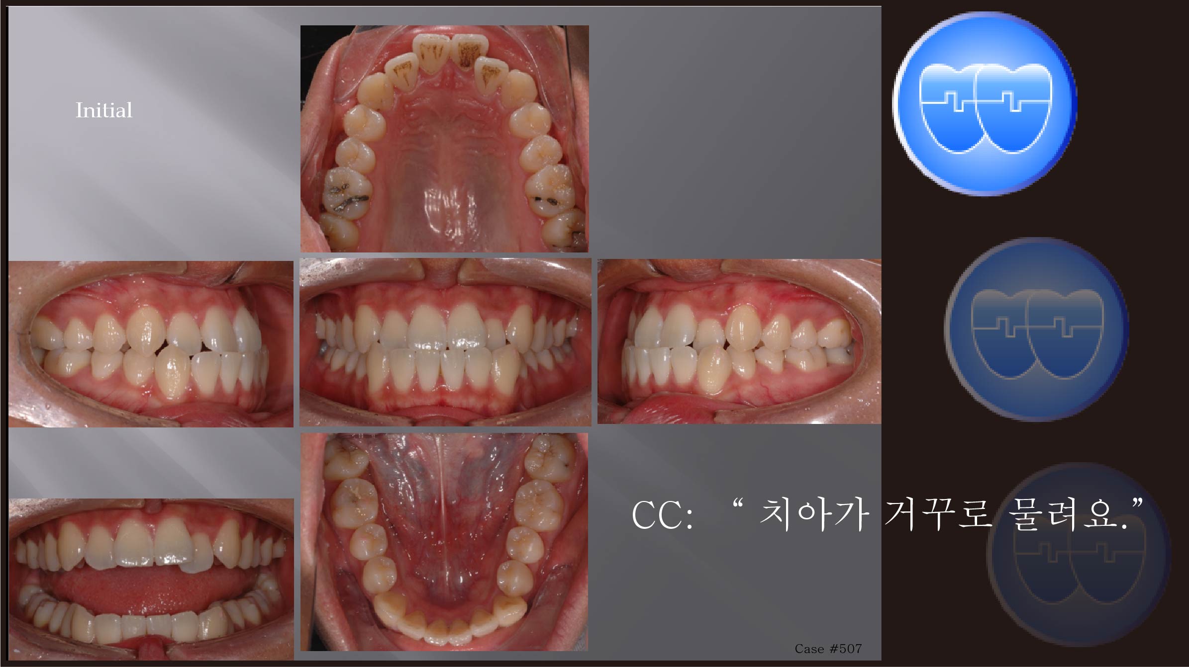 교정 Case 507.  L5 발치, Class III, Anterior Crossbite, Sem #12.8