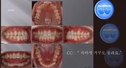 교정 Case 507.  L5 발치, Class III, Anterior Crossbite, Sem #12.8