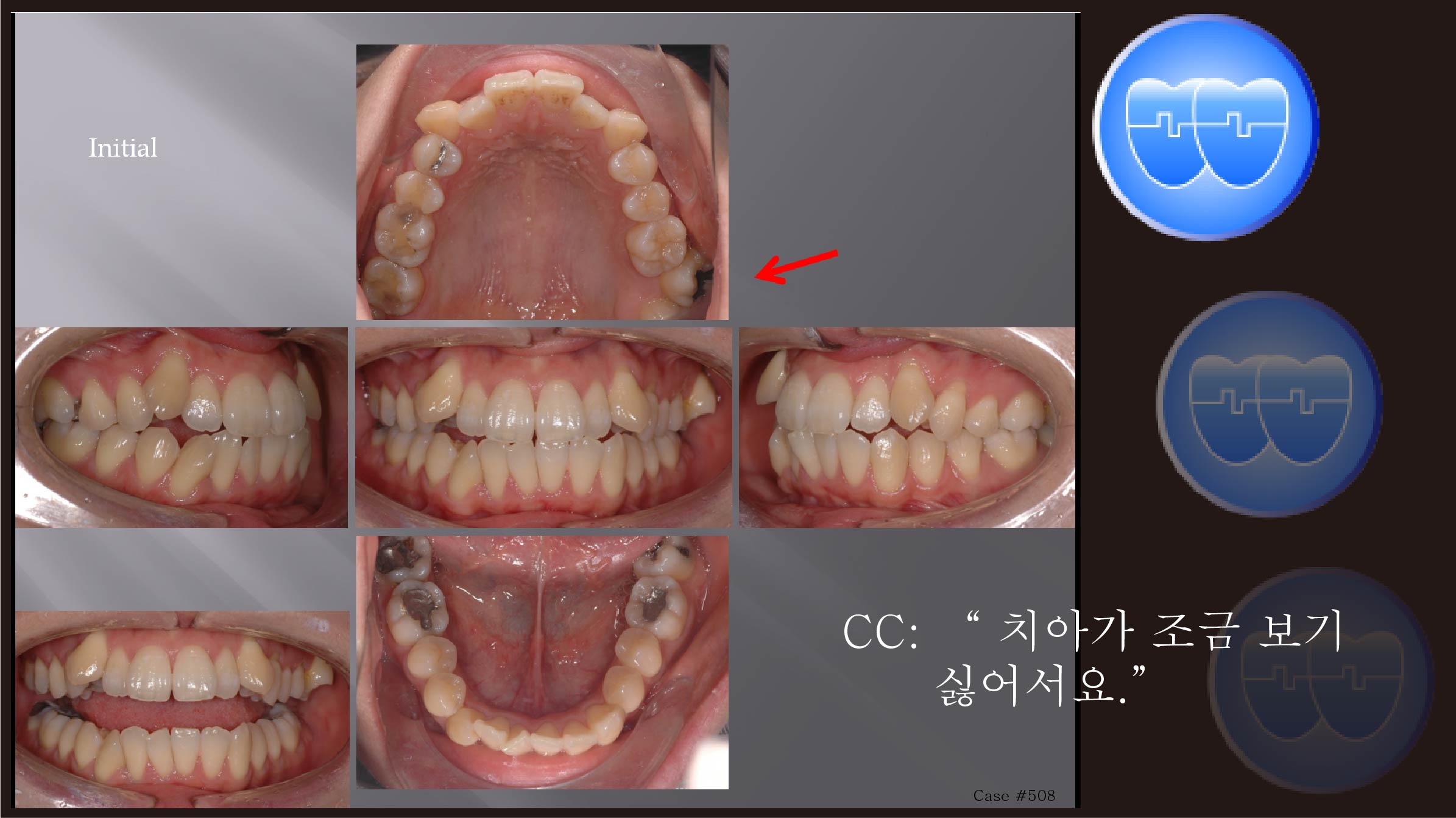 교정 Case 508. U5L4 발치, Class I, Severe Crowding, Scissor-bite, Root Resorption, Anterior Crossbite, Sem #12.3