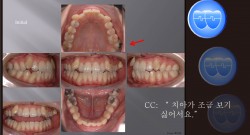 교정 Case 508. U5L4 발치, Class I, Severe Crowding, Scissor-bite, Root Resorption, Anterior Crossbite, Sem #12.3