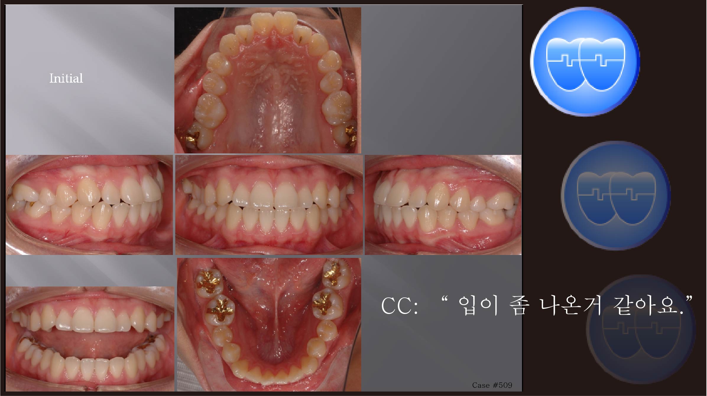 교정 Case 509.  U5L4 발치, Protrusion, Sem #12.3