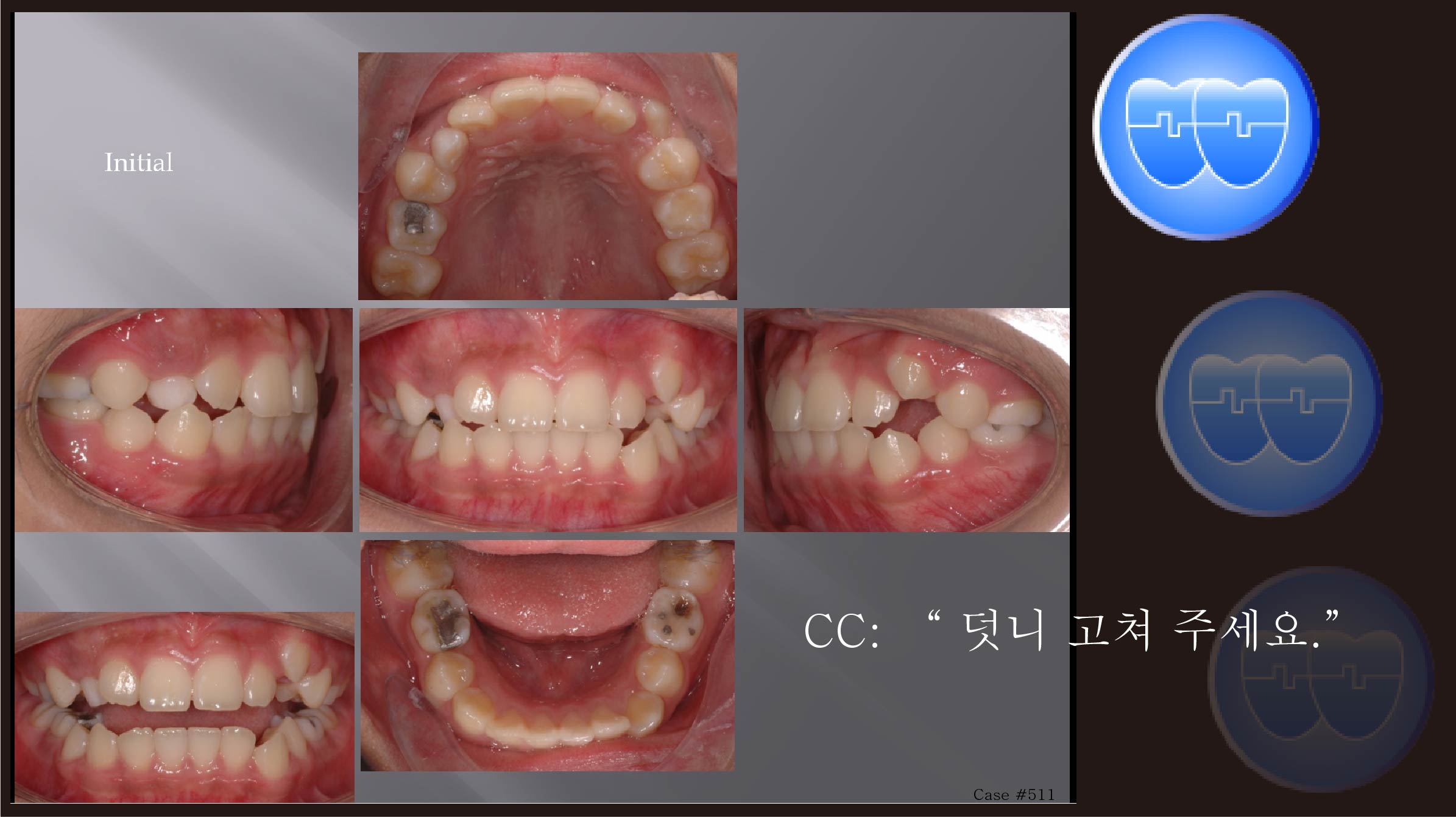 교정 Case 511.  비발치, Expansion과 Stripping으로만 Retraction, Sem #2