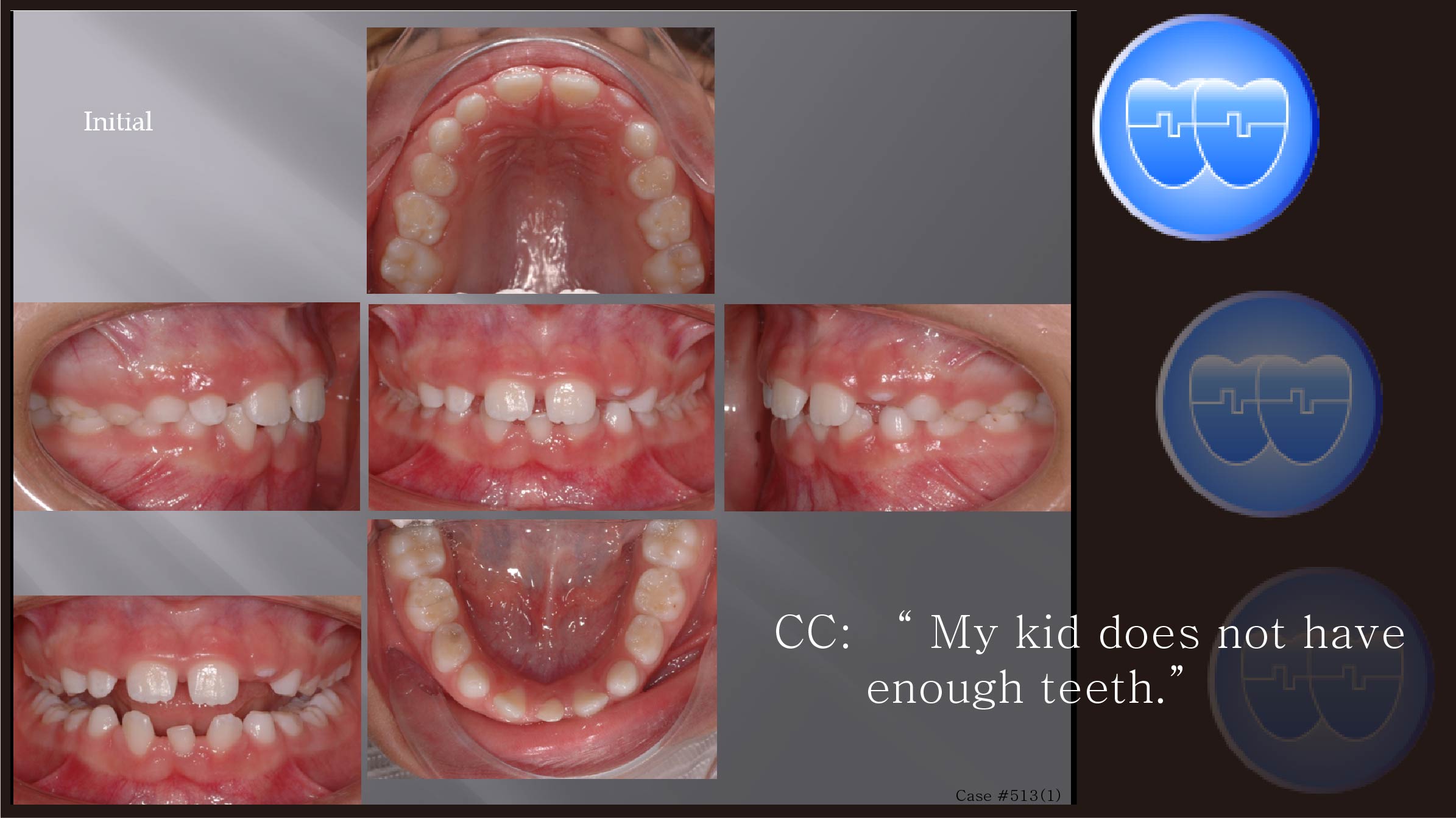 교정 Case 513(1).  Congenital Missing of Two Lower Incisors, Phase I, Sem #9