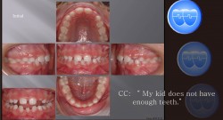 교정 Case 513(1).  Congenital Missing of Two Lower Incisors, Phase I, Sem #9