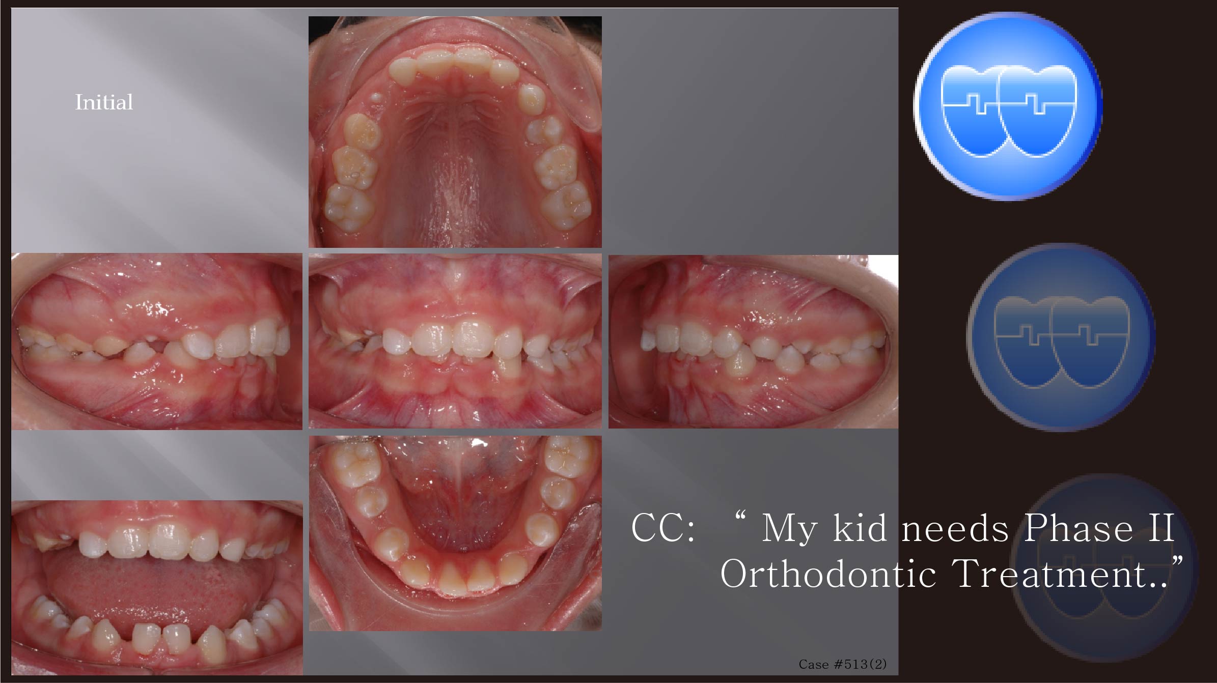 교정 Case 513(2).  Congenital Missing of Two Lower Incisors, Lower Miniscrews, Sem #13