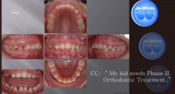 교정 Case 513(2).  Congenital Missing of Two Lower Incisors, Lower Miniscrews, Sem #13