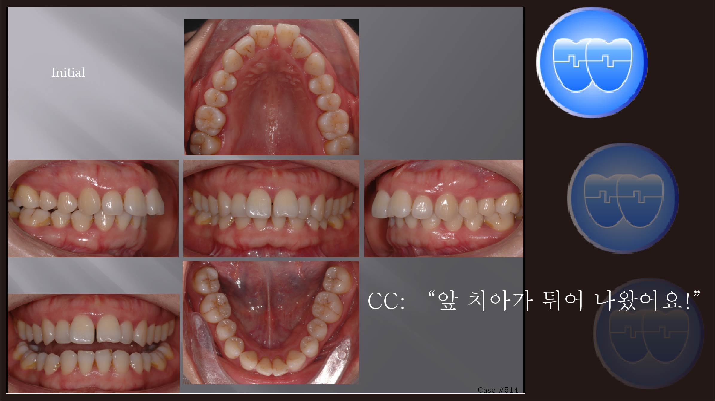 교정 Case 514.  U5 발치, Congenital Missing of Two Lower Incisors, Sem #11