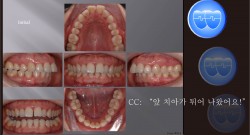 교정 Case 514.  U5 발치, Congenital Missing of Two Lower Incisors, Sem #11