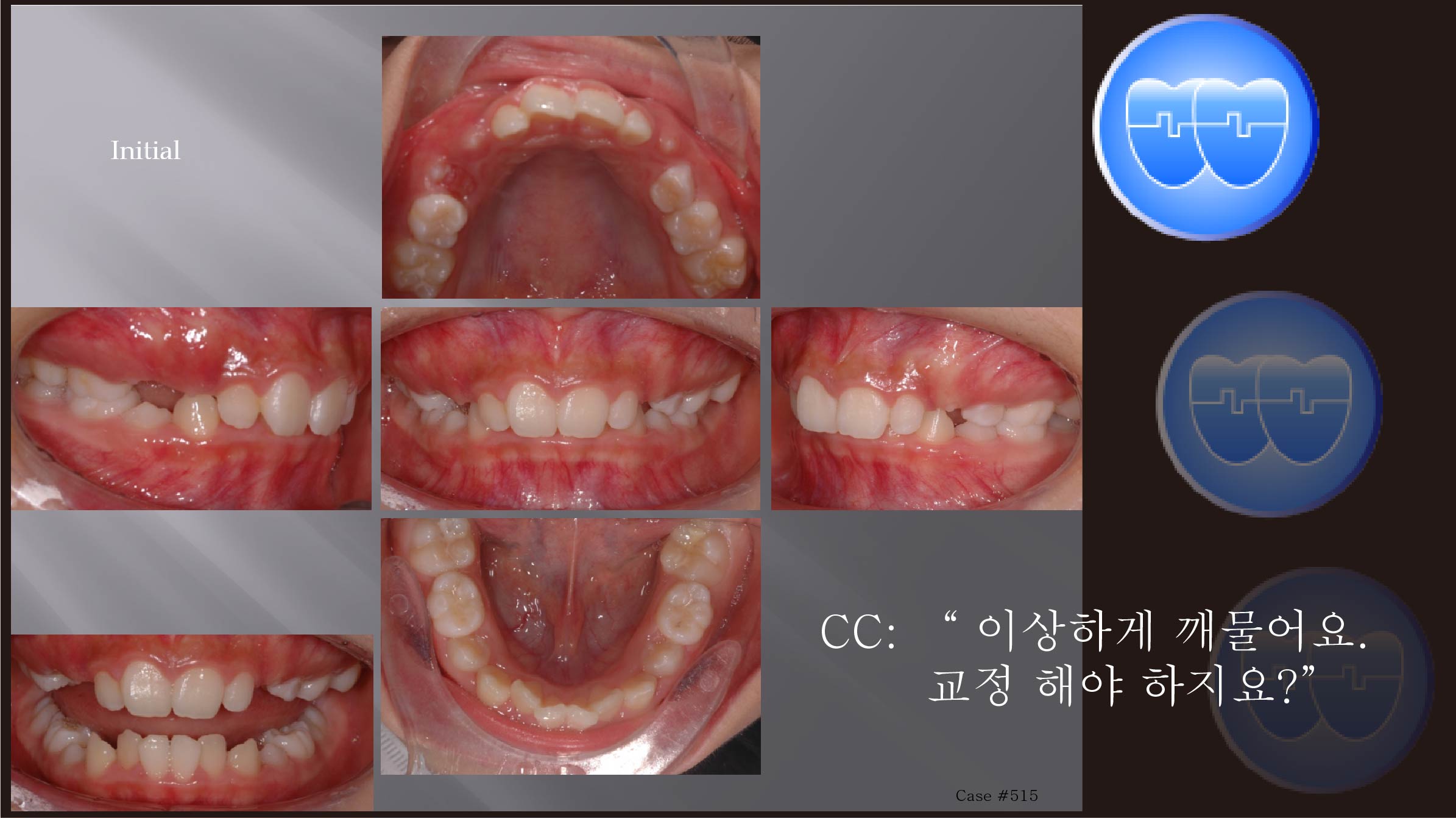 교정 Case 515.  비발치, Class II, Dental Deepbite, Sem #6