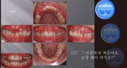 교정 Case 515.  비발치, Class II, Dental Deepbite, Sem #6