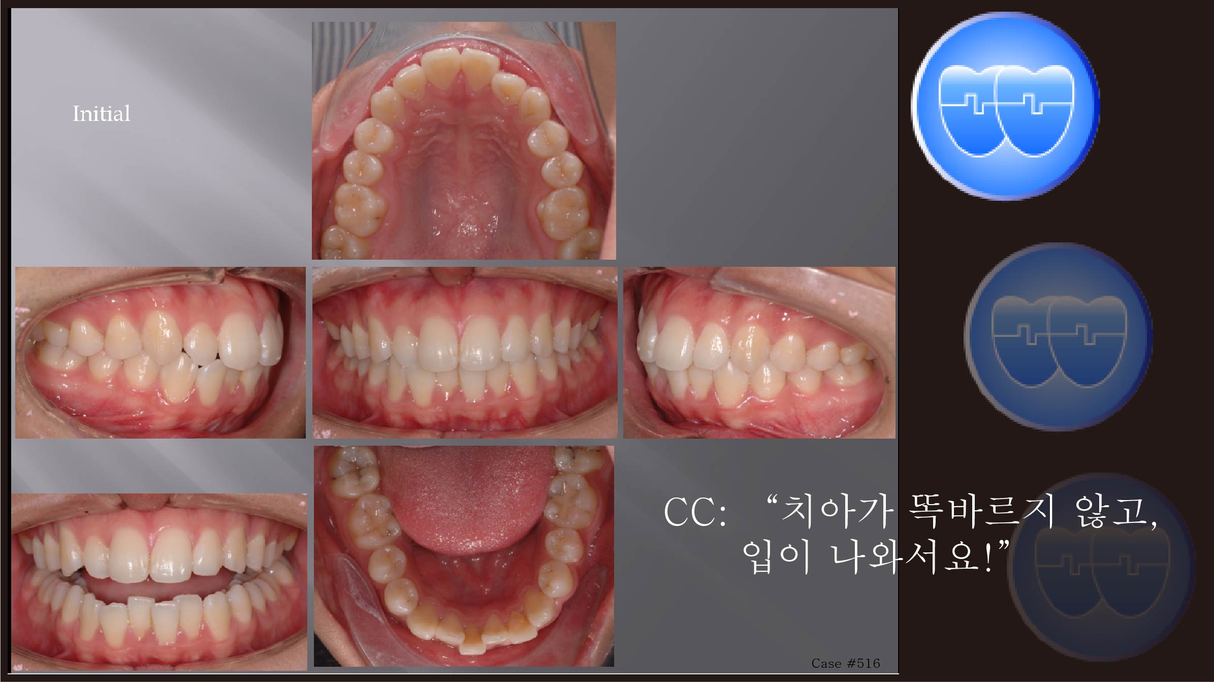 교정 Case 516.  U5L4 발치, Protrusion, Root Resorption, Sem #12.3