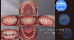 교정 Case 516.  U5L4 발치, Protrusion, Root Resorption, Sem #12.3