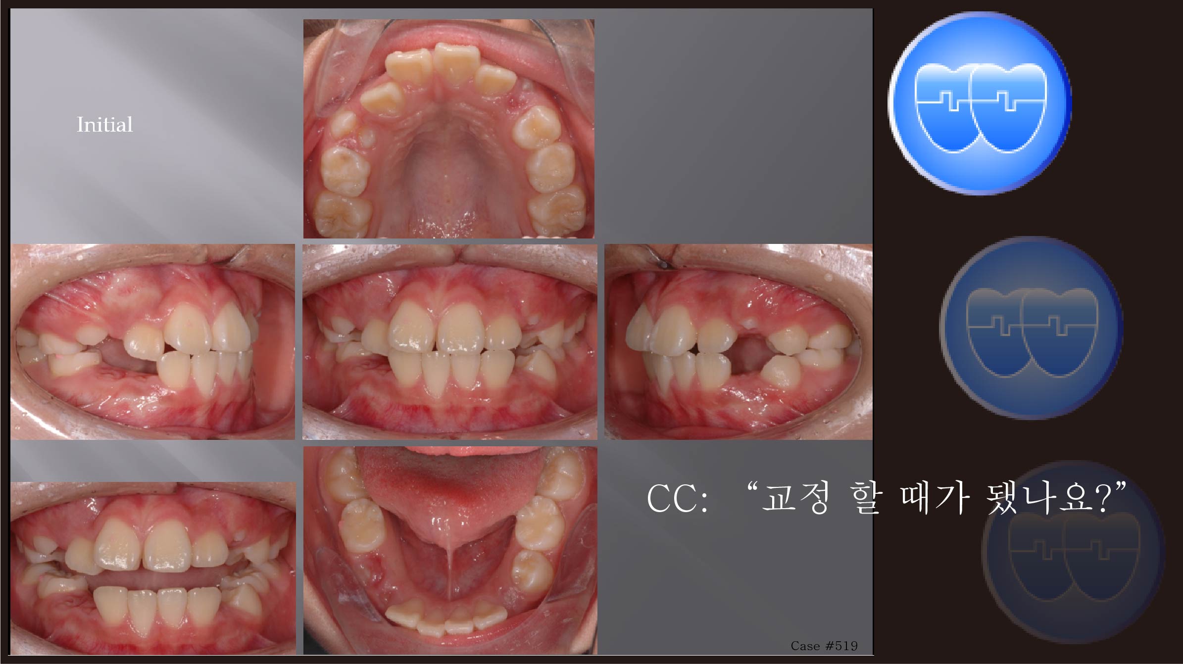 교정 Case 519.  U4L4 발치, 진단실수, 비발치로 시작, Sem #12.1