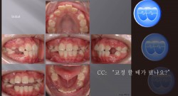 교정 Case 519.  U4L4 발치, 진단실수, 비발치로 시작, Sem #12.1