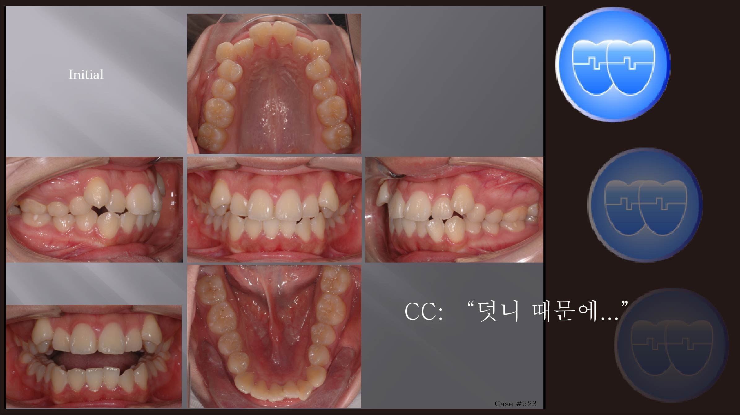 교정 Case 523.  U5L4 발치, High Canine, Sem #12.3