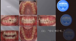 교정 Case 523.  U5L4 발치, High Canine, Sem #12.3