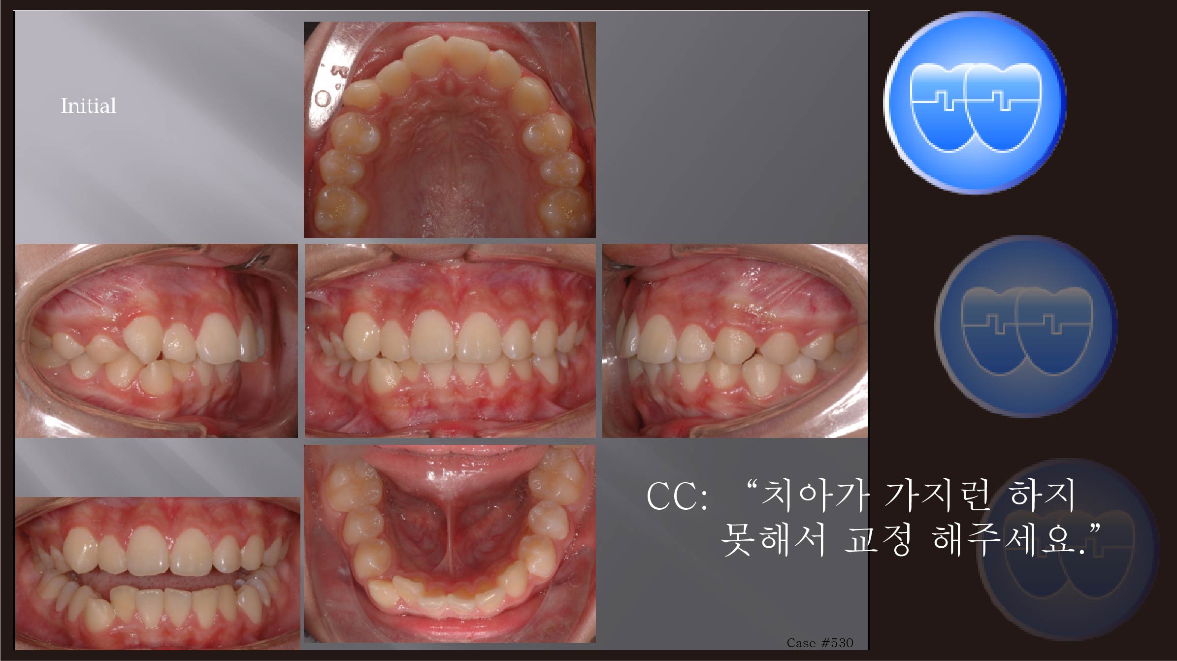 교정 Case 530.  U4L4 발치, Protrusion, U5번 앞 Miniscrew 위치, Sem #12.1