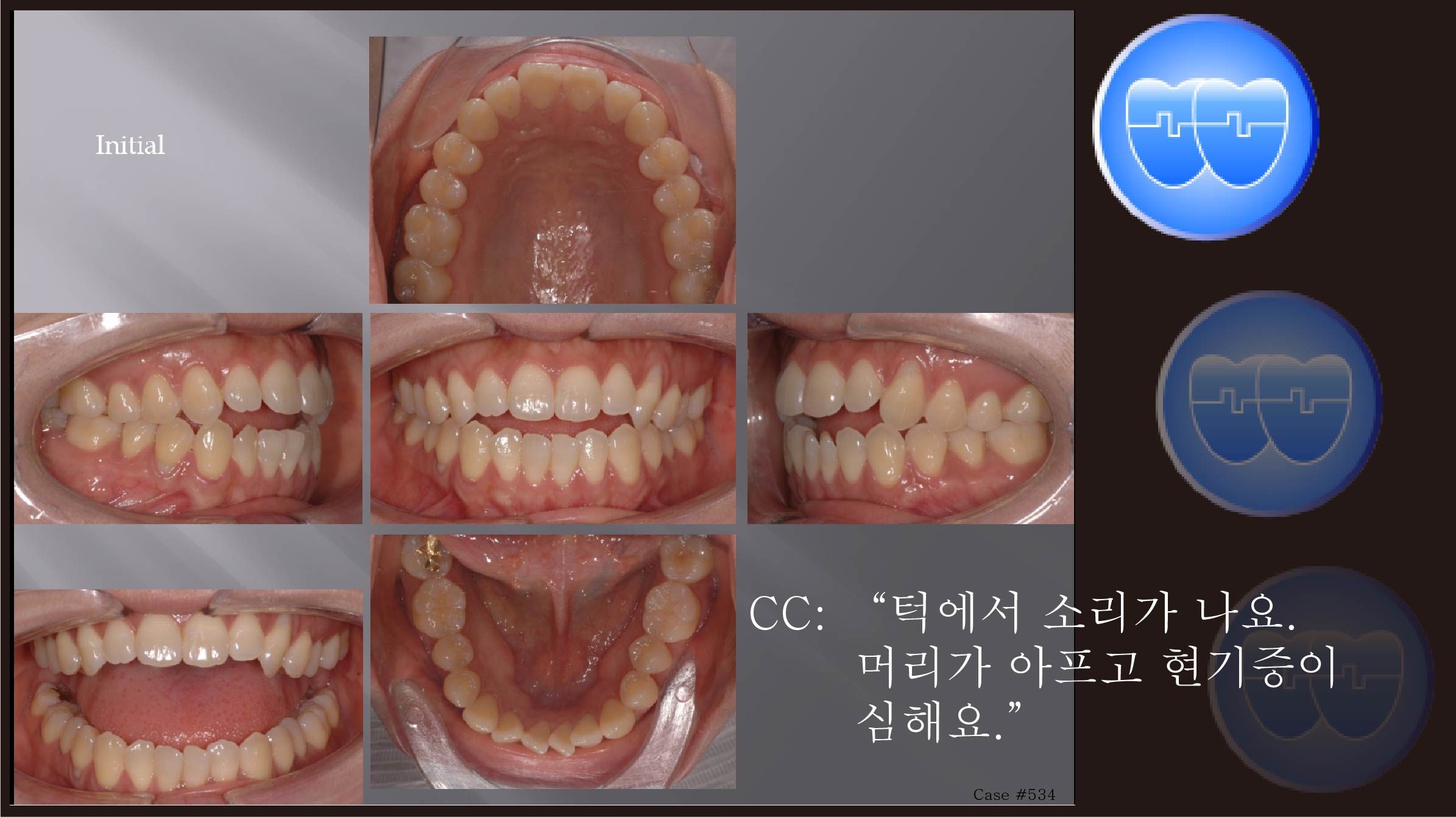 교정 Case 534.  U5L5 발치, Severe TMJ Pt. Root Resorption, Sem #19