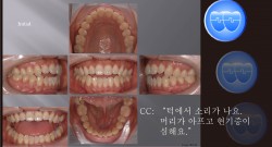 교정 Case 534.  U5L5 발치, Severe TMJ Pt. Root Resorption, Sem #19