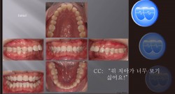 교정 Case 537.  U4 발치, Class II, Big Overjet, Dental Deepbite, Sem #12.5